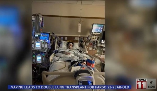 Парень постоянно курил вейп. Итог — полная пересадка легких